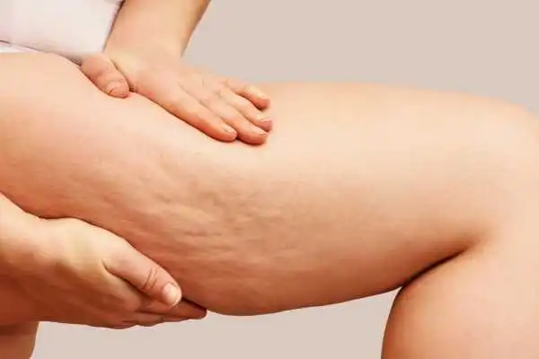 Image of woman showing leg with cellulite Brierley Hill