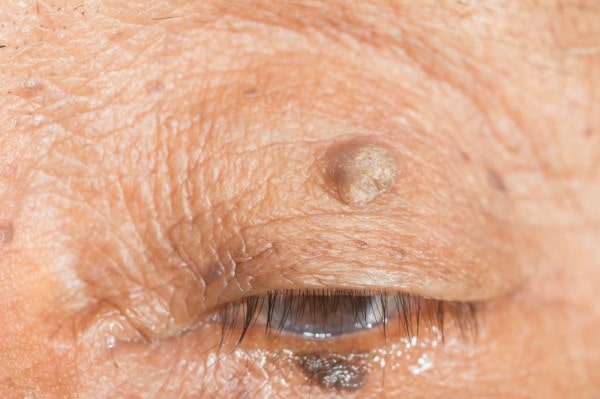 Skin imperfections Brierley Hill - Cryopen is fast and effective book in today!