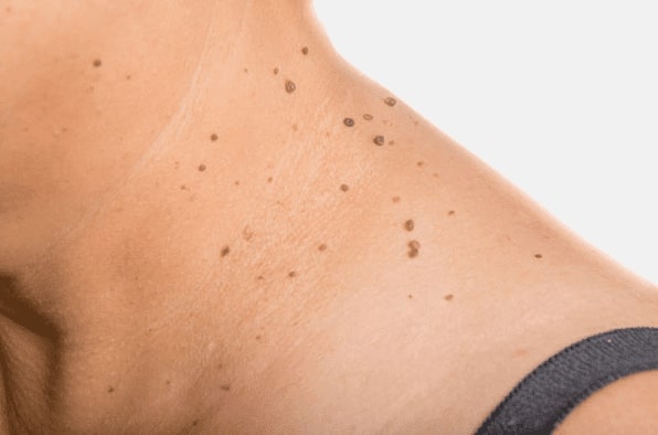 Are you looking for easy skin tag removal Brierley Hill - then contact Spire today!