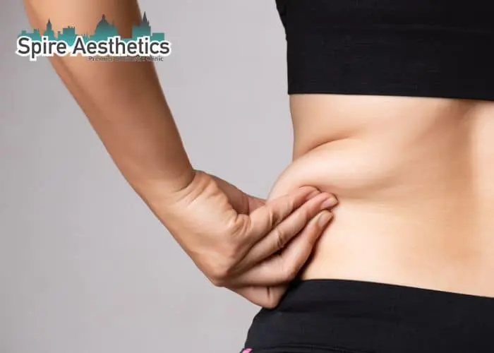 Image of woman pinching fat on their hips Brierley Hill. Fat Freezing treatment