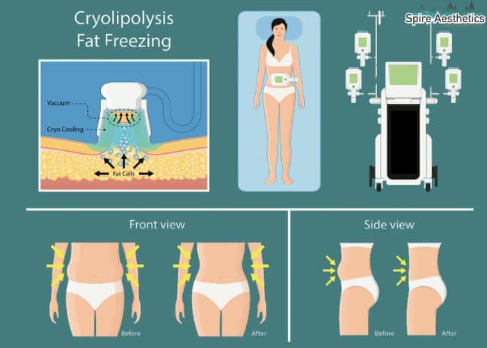 Image of diet and fat freezing combined for best results for Spire Aesthetics Brierley Hill