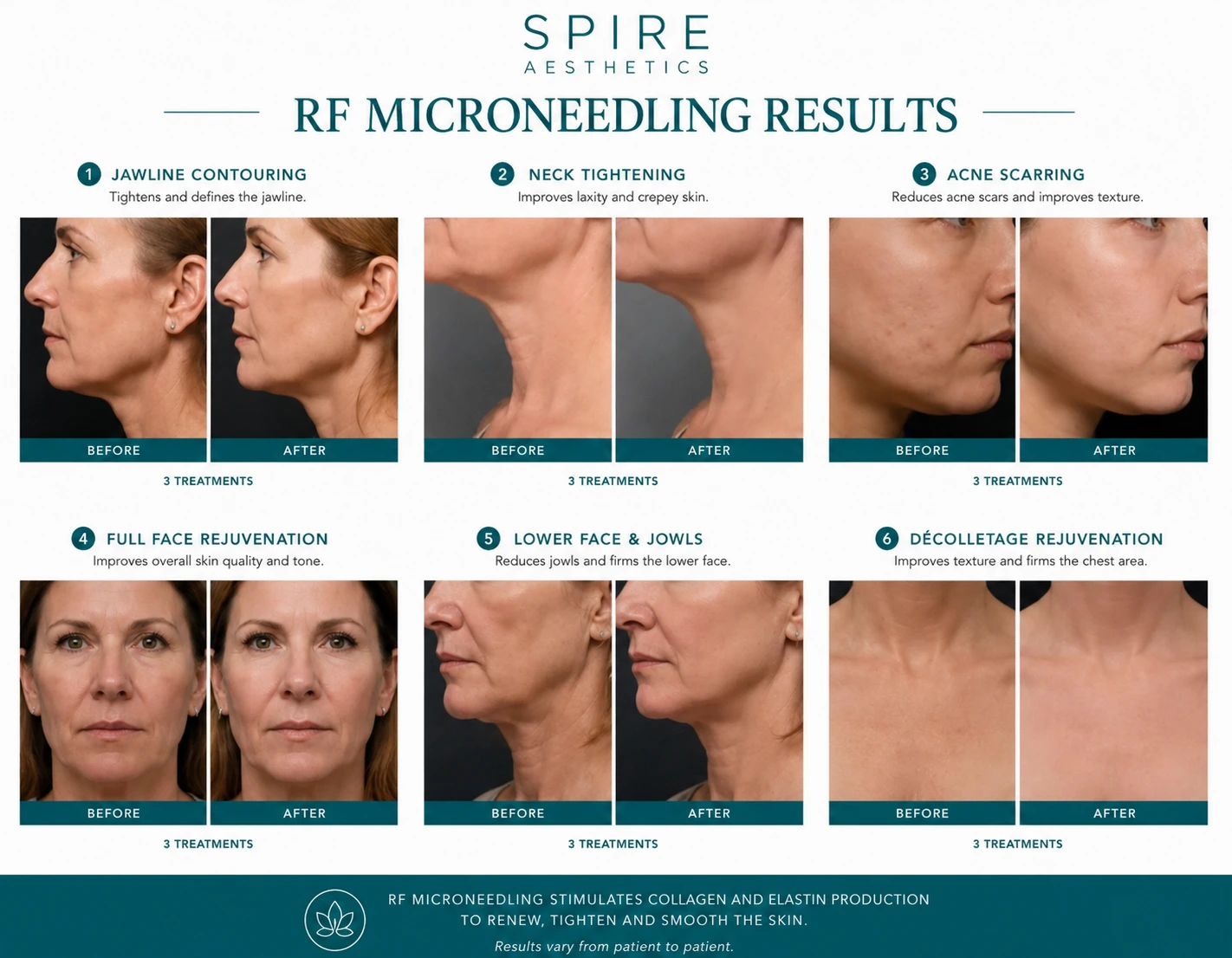 RF Microneedling Skin tightening Brierley Hill results