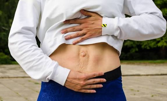 When Could Diastasis Recti Be the Missing Piece of the Puzzle Brierley Hill?